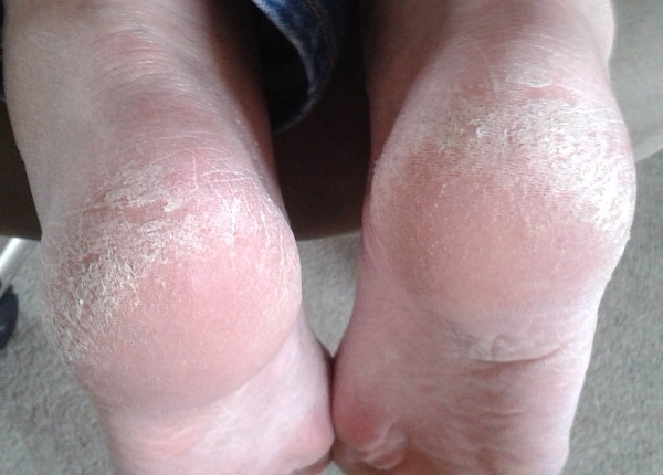 Dry cracked heels